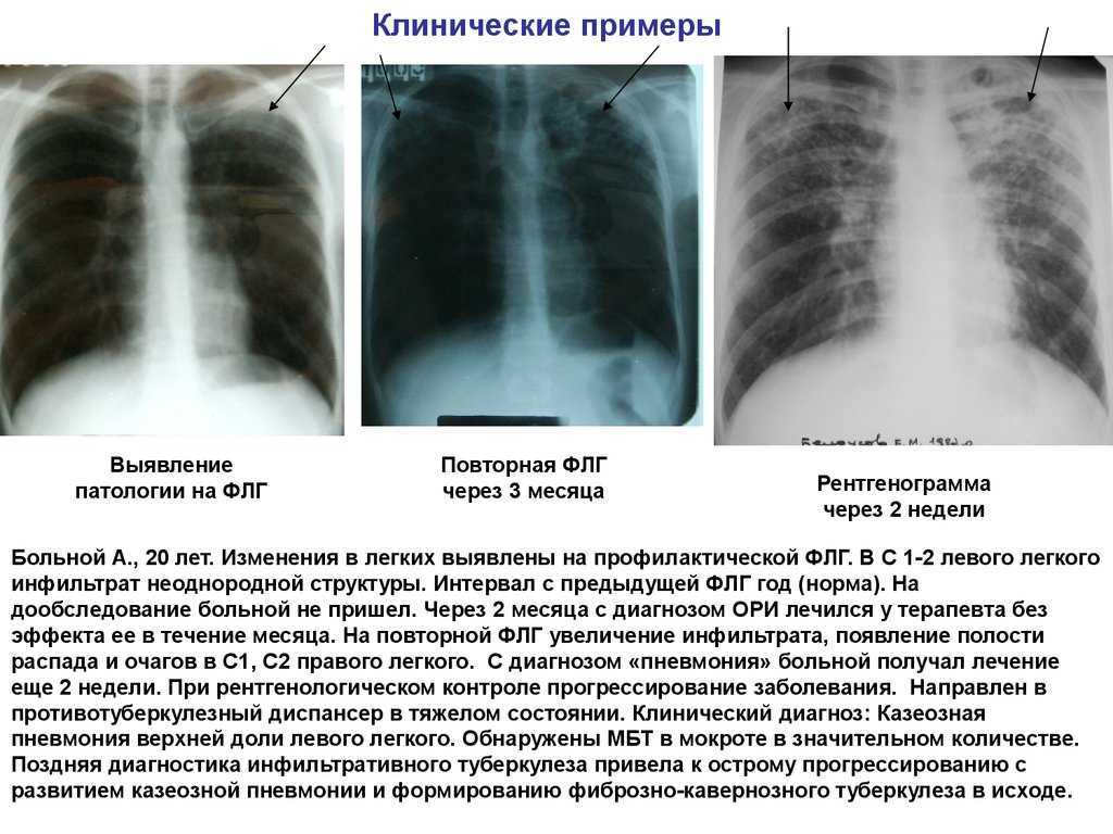 Легочный рисунок усилен что это значит