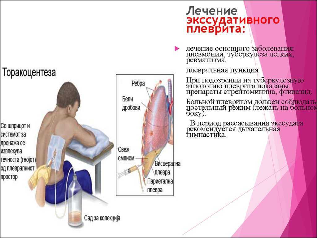 Плевральный фиброз и кальциноз - обычно доброкачественные осложнения воспаления плевры или экспозиции асбесту