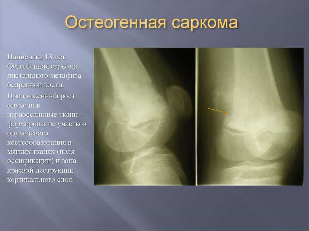 Опухоли костей и мягких тканей презентация