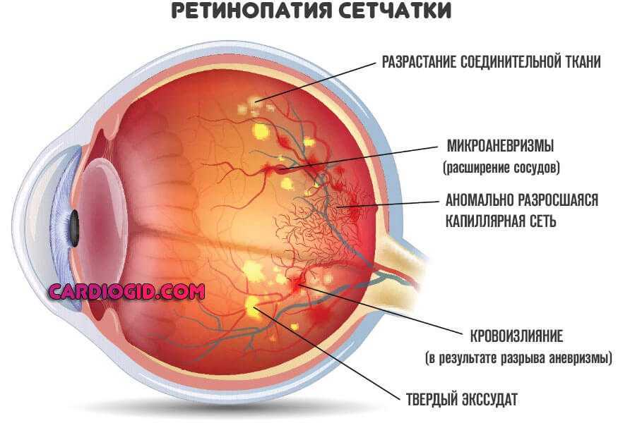 Ангиопатия сосудов сетчатки что это. Ангиопатия и ретинопатия сетчатки. Почечная ретинопатия глазное дно. Отслоение сетчатки - ретинопатия.. Диабетическая микроангиопатия ретинопатия.