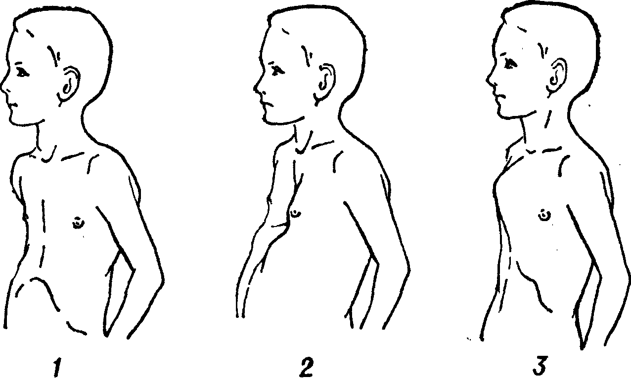Грудная клетка у ребенка норма. Синдром Марфана деформация грудной клетки. Килевидная грудная клетка у ребенка 2-3года. Килевидная грудная клетка при рахите. Воронкообразная и килевидная деформация грудной клетки у детей.