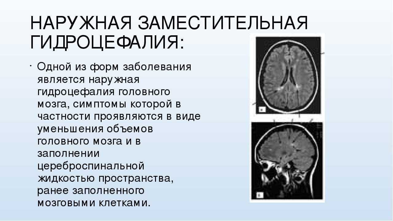 Наружная гидроцефалия мозга