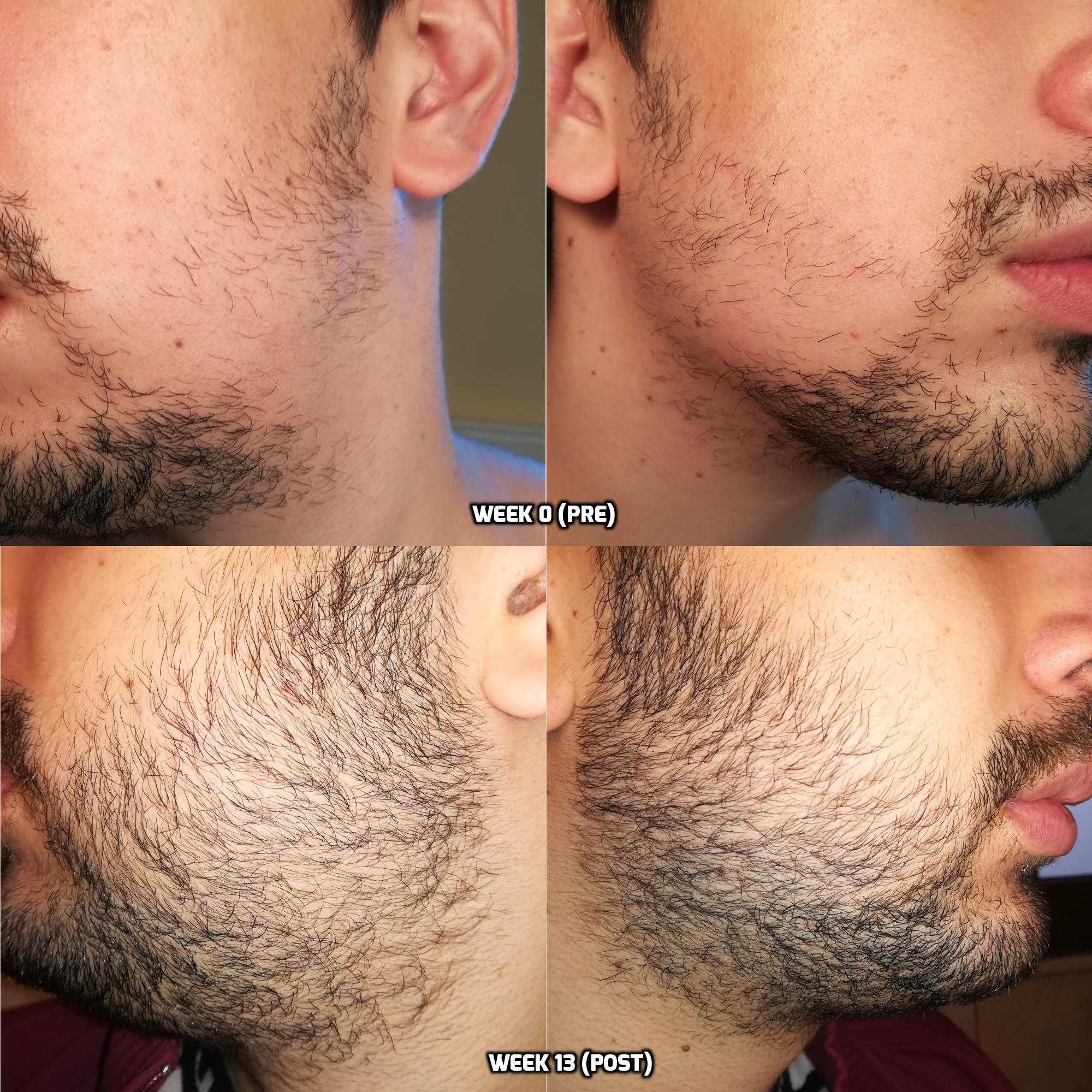 Как брить бороду триммером против роста или по росту волос или против