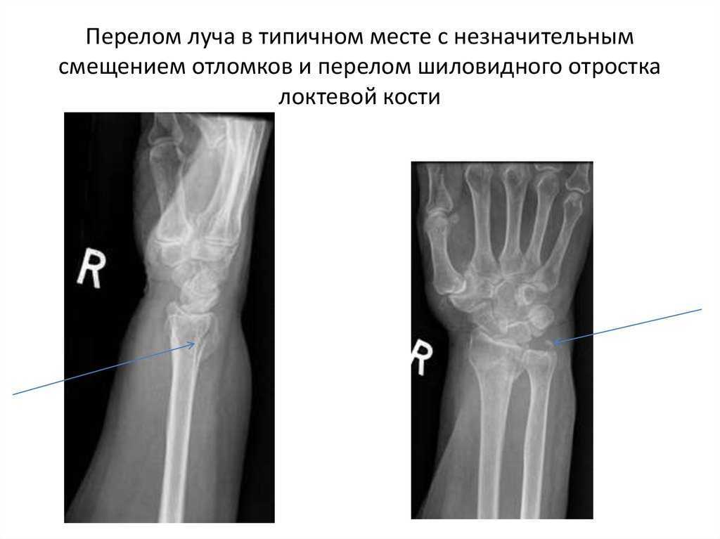 Анатомия костей предплечья человека – информация: