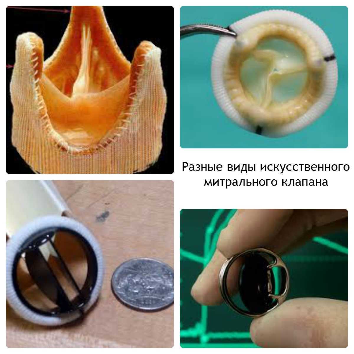 Протез клапана. Искусственный аортальный клапан сердца. Искусственный митральный клапан сердца. Протез клапана сердца митральный клапан. Механический искусственный митральный клапан.