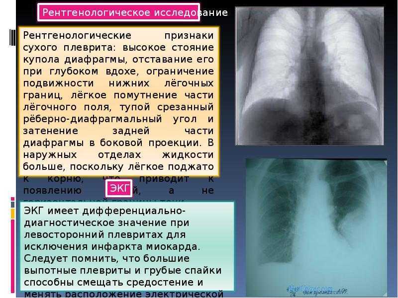 Экссудативный плеврит клиническая картина