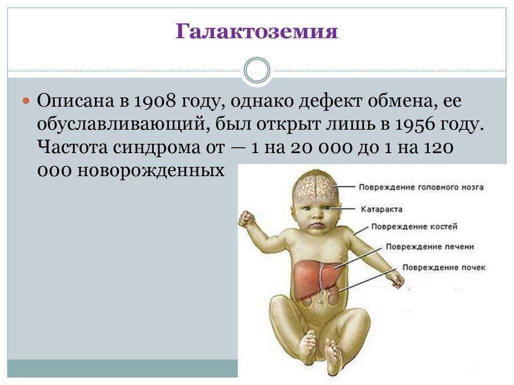 Галактоземия презентация по педиатрии