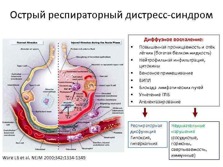 Острый лейкоз. онкология