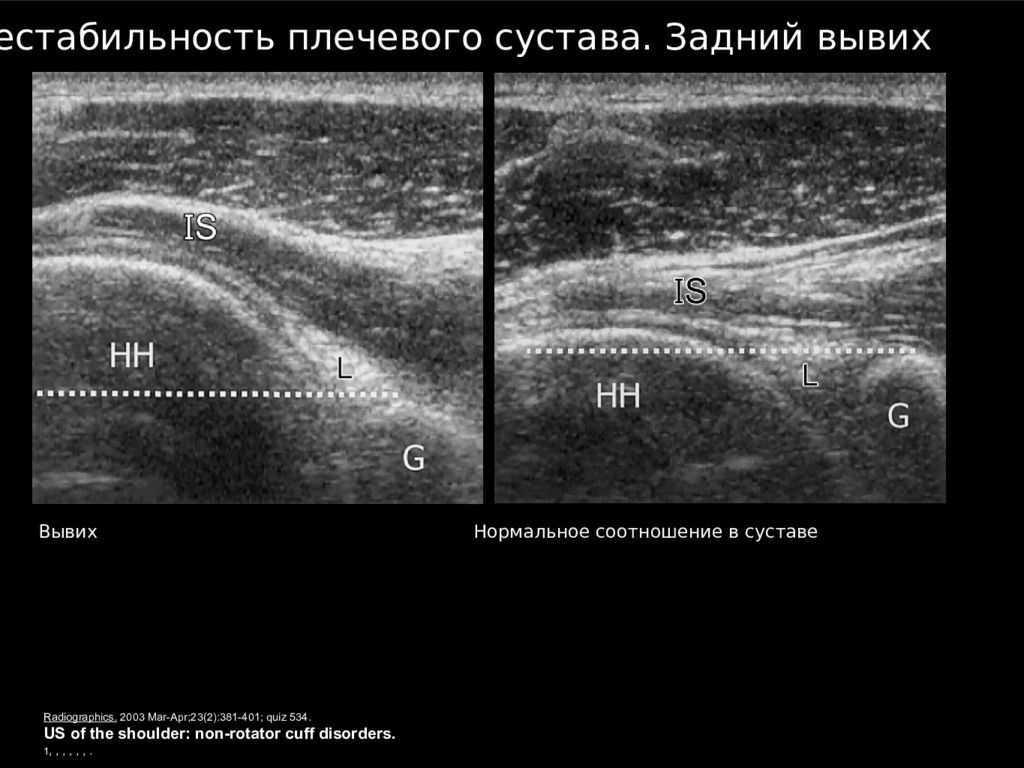 Акромиально ключичный артроз: признаки и лечение