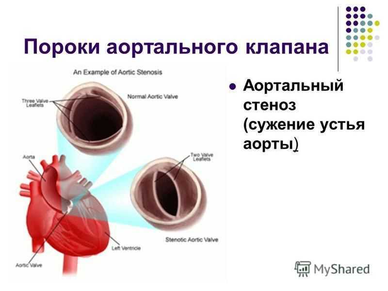 Аортальный стеноз что это такое. Порок аортального клапана сердца. Порок сердца стеноз аортального клапана. Стеноз аортального клапана гемодинамика. Врожденный двустворчатый аортальный клапан.