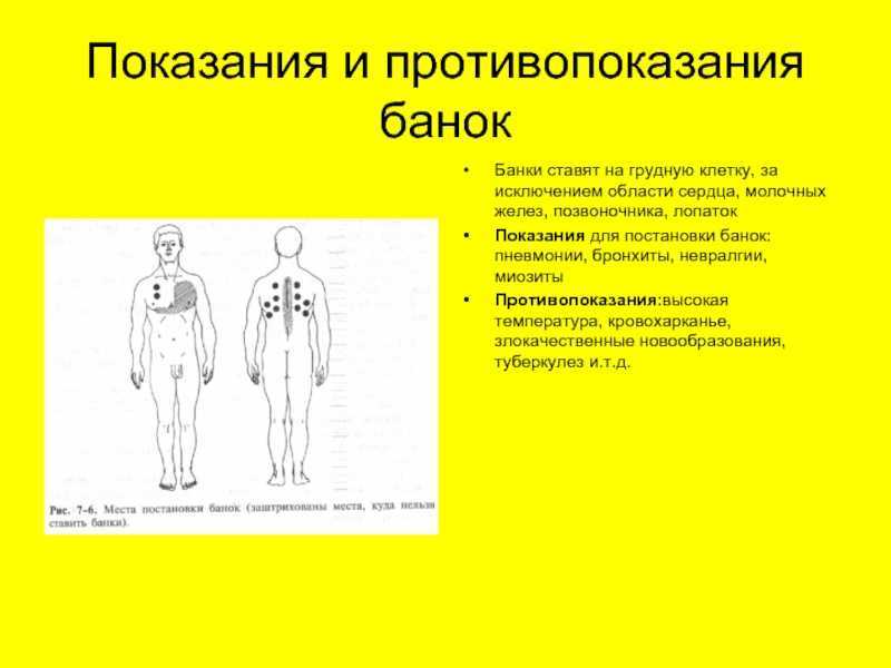 На сколько минут ставить банки на спину при кашле взрослому и схема