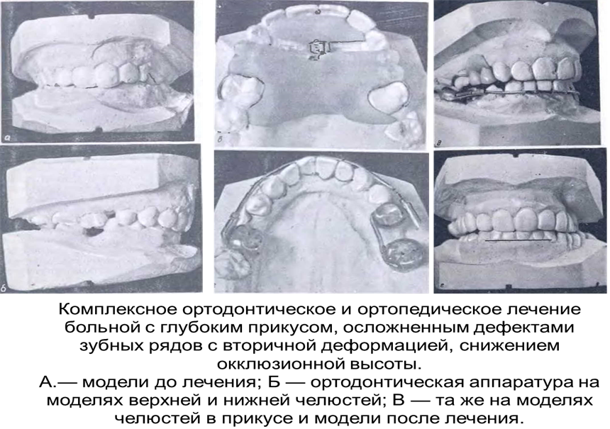 Ортопедический этап лечения. Классификация деформаций зубных рядов. Деформация окклюзионной поверхности зубных рядов. Вторичные деформации зубных рядов.