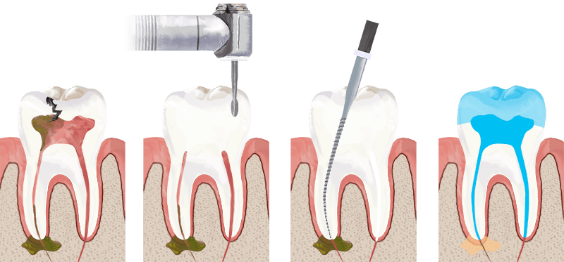 Пломбирование каналов зубов: подготовка, материалы, врачи
