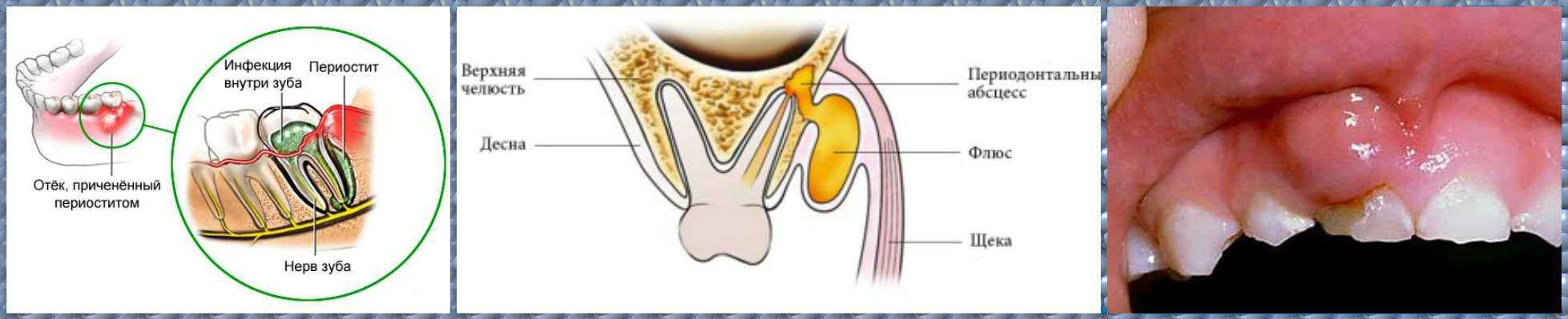 Периостит клиническая картина