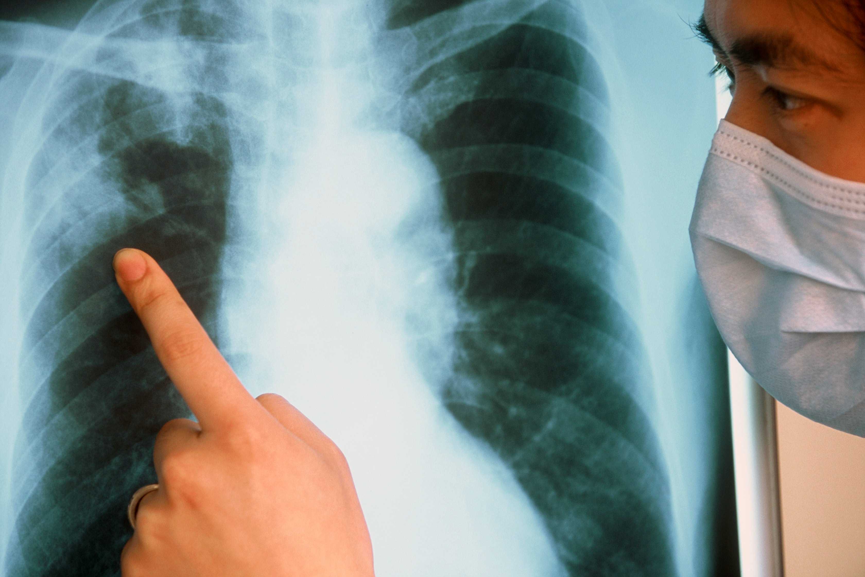 Туберкулез: что таит в себе данное заболевание | клиника в уручье