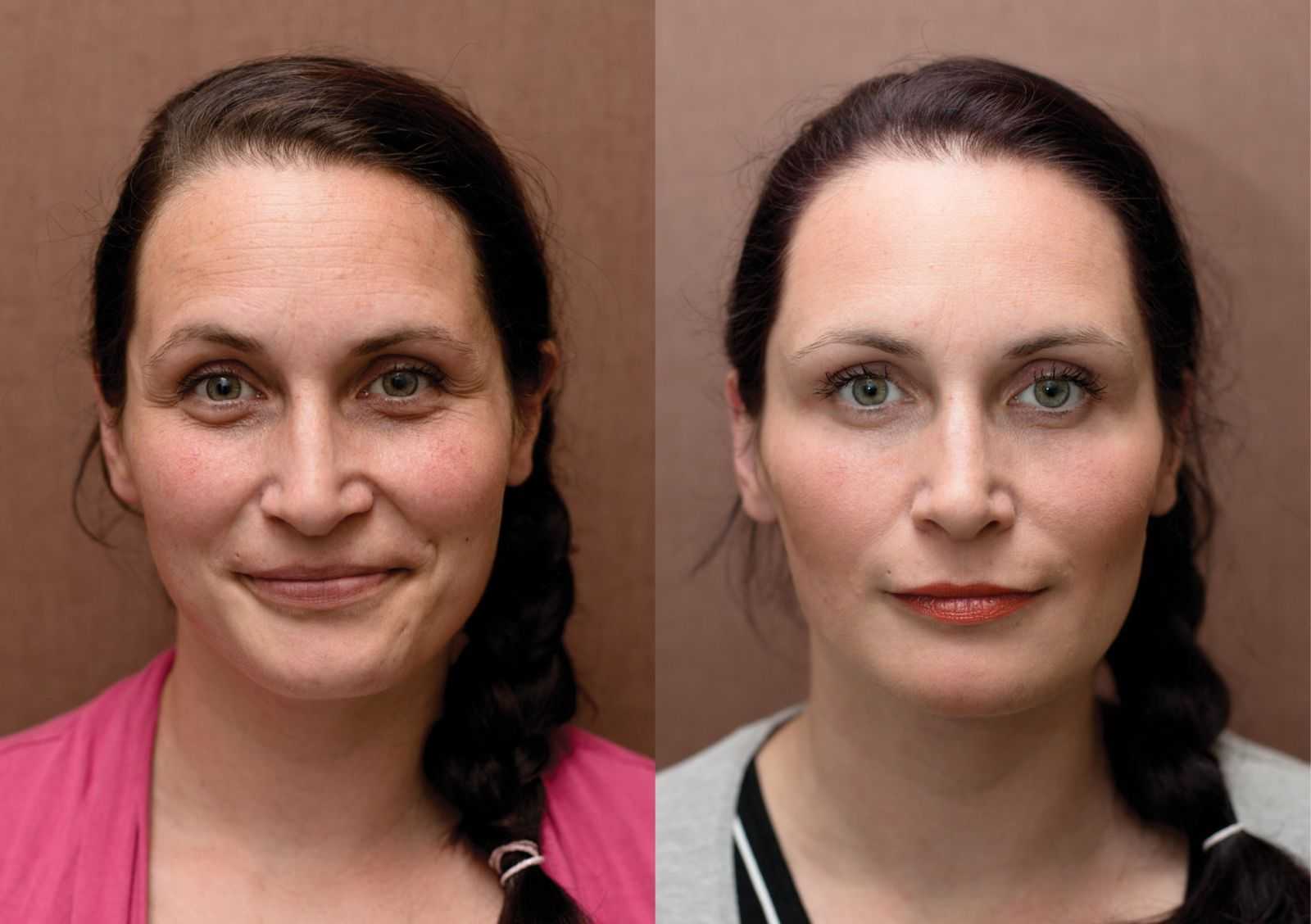 Биоревитализация глаз эффект. Морщины до после. Мезотерапия для лица до и после. Мезотерапия глаз до и после. Лицо до после.