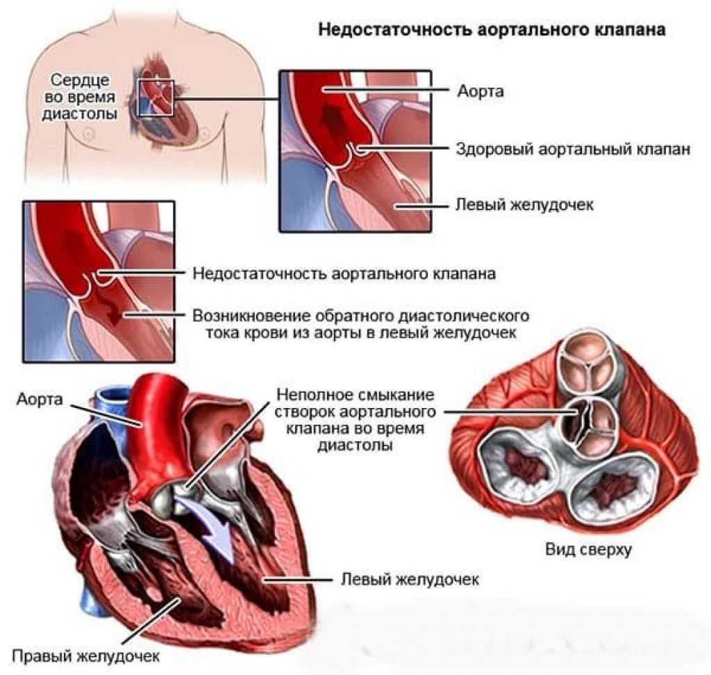 Гемодинамика пациента. Аортальная клапанная недостаточность. Недостаточность аортального клапана. Проявления недостаточности аортального клапана. Аортальный клапан первой степени.