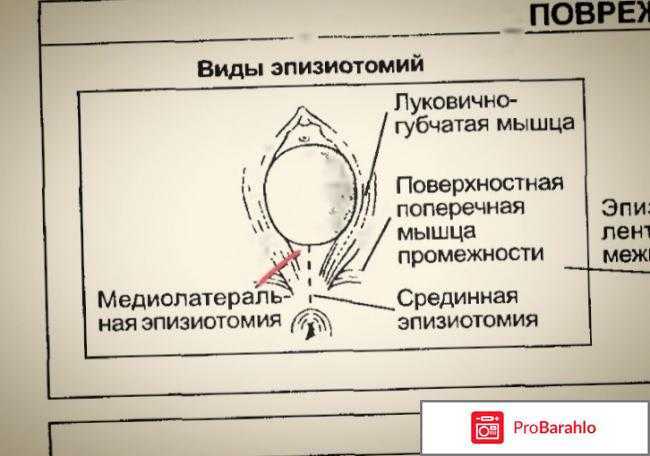 Последствия вакуумной экстракции плода