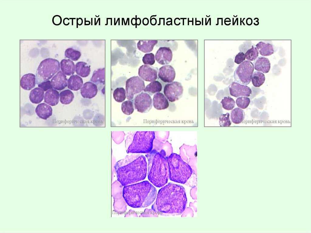 Картина острого лейкоза