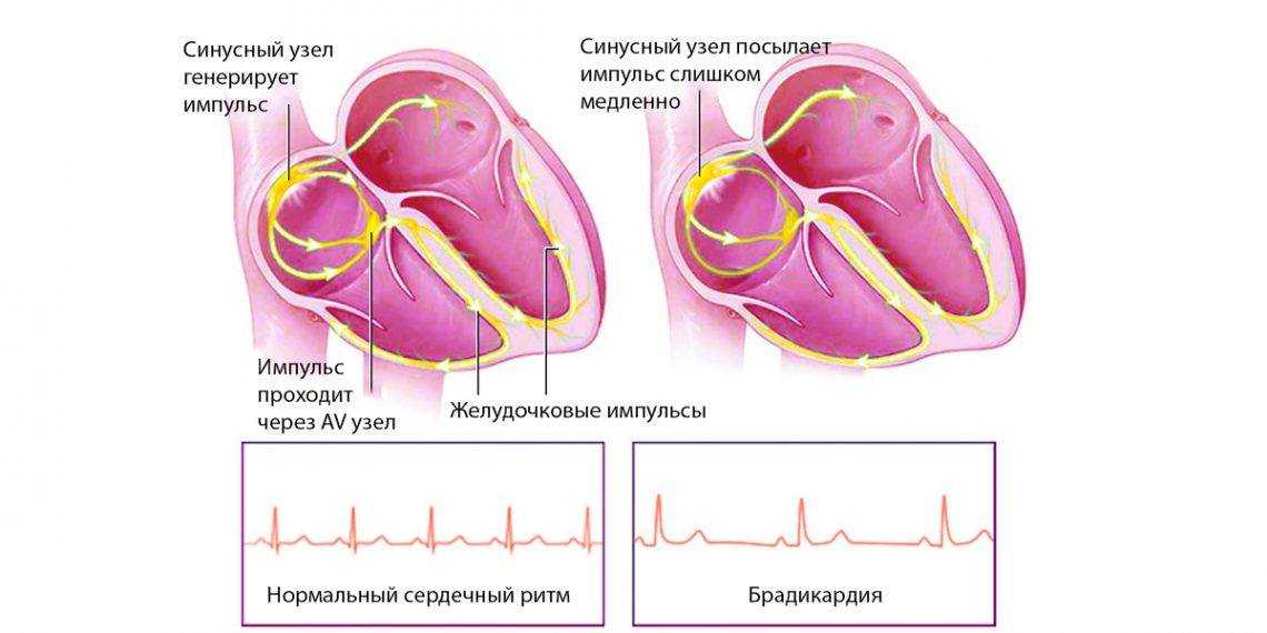 Ключевые причины, вызывающие синусовую брадикардию – нарушения в проводящей системе сердца, главную роль в которой играет синусный или синоатриальный узел