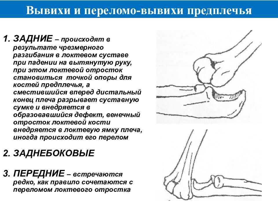 Вывих локтевого сустава карта вызова