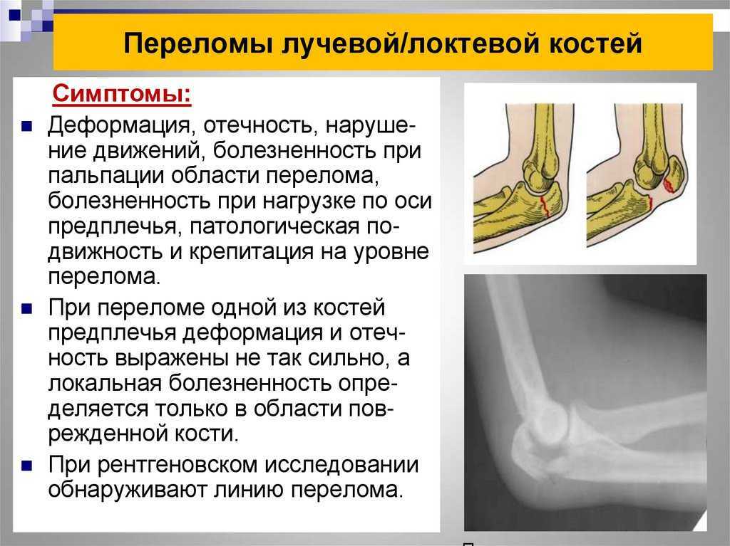 Какой вид травмы скелета изображен на рисунке растяжение связок перелом кости трещина кости вывих