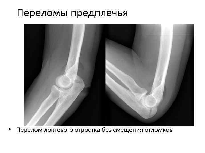 Анатомия костей предплечья