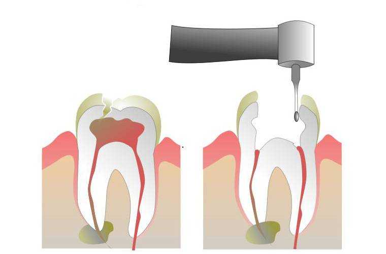 Чистка каналов зуба – это стоматологическая манипуляция, которая проводится при попадании инфекции в корневые каналы