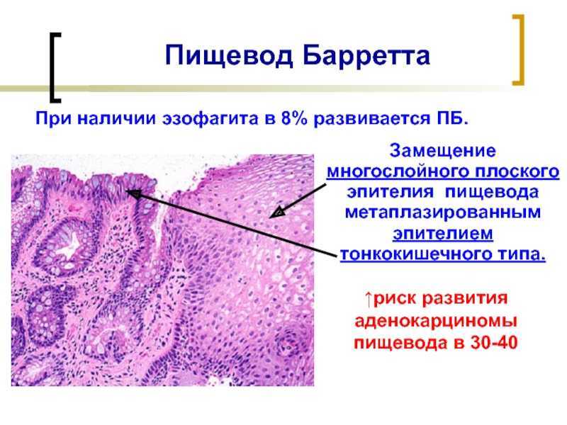 Гастроэзофагеальная рефлюксная болезнь (гэрб)