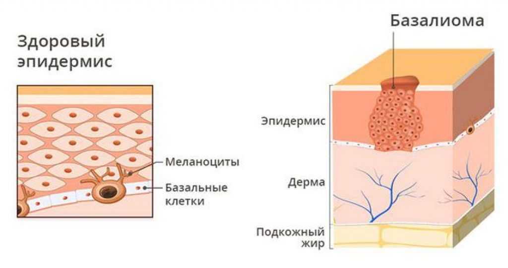 Распад кожи. Базалиома склеродермоподобная форма. Склерозирующая базалиома. Фотодинамическая терапия базалиома.
