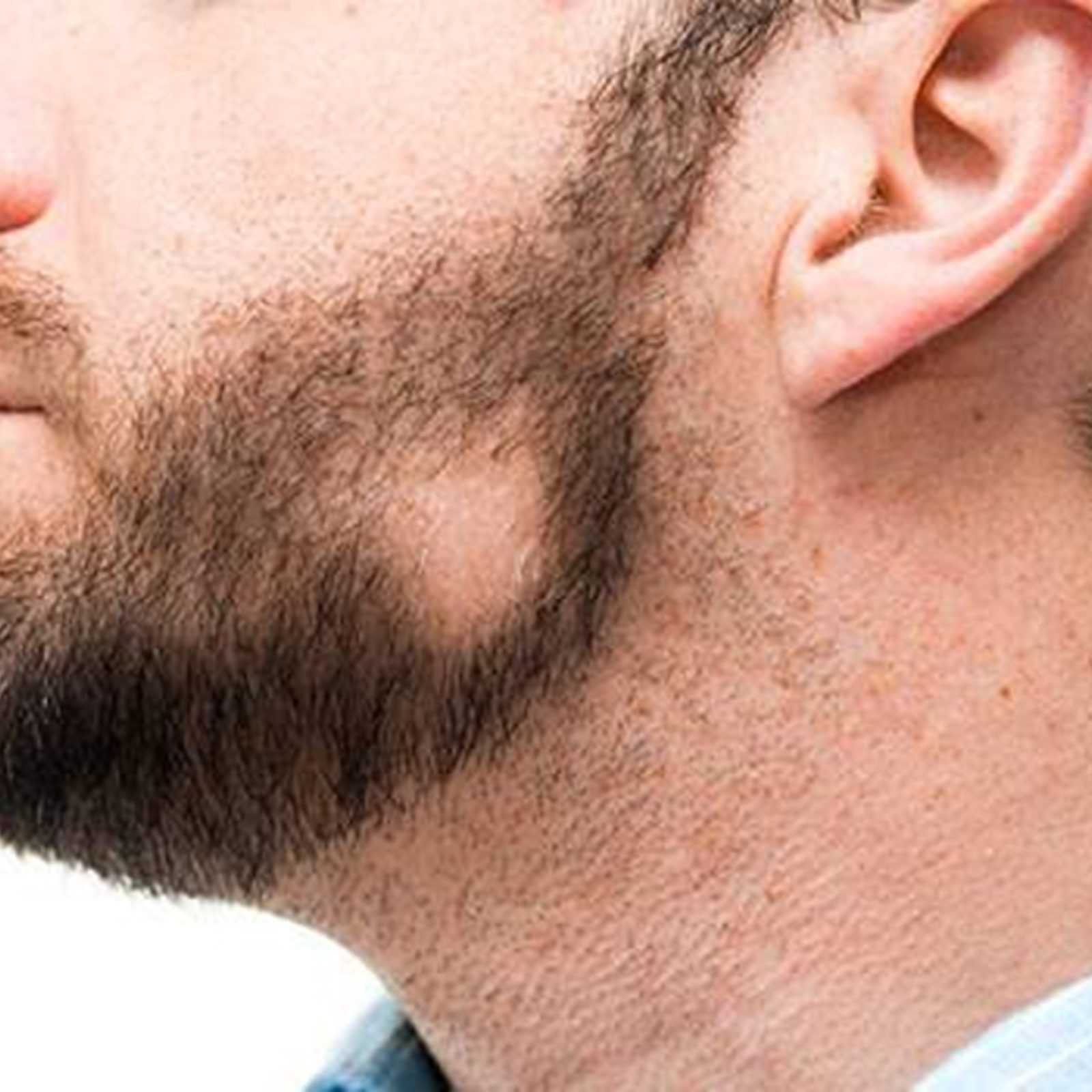 Рост волос на лице у парней