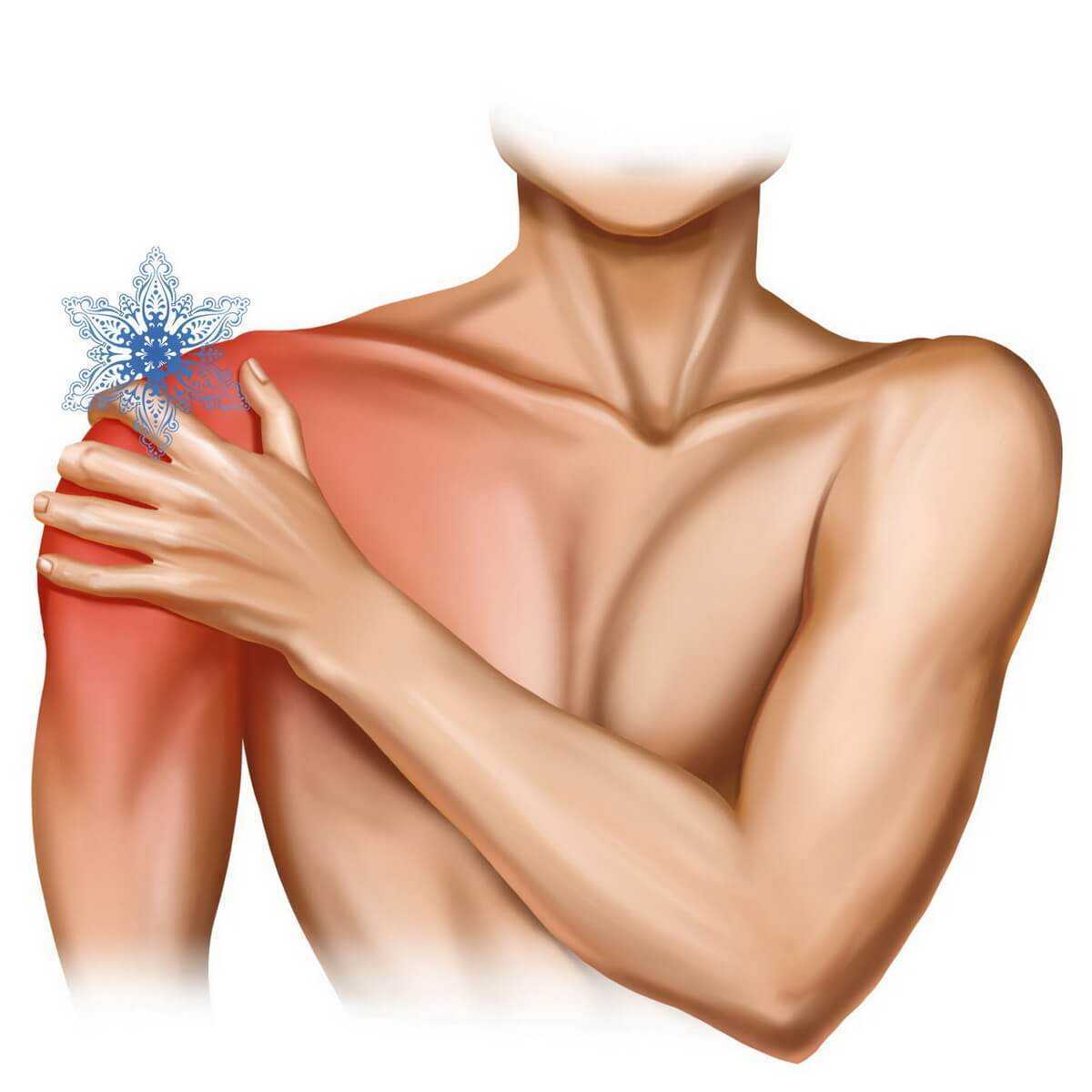 При поднятии руки вверх боль в плече. Плечелопаточный периартериит. Синдром замороженного пле. Заболевания и травмы плеча.