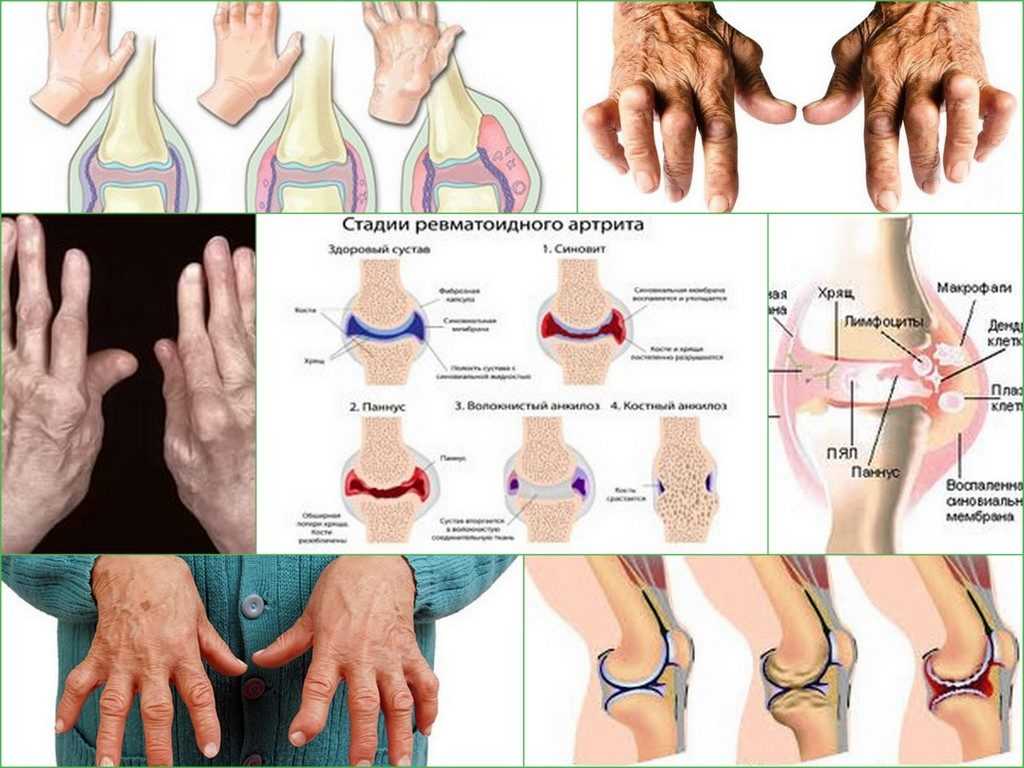 Диагностика и лечение ревматоидного артрита (александров) | парацельс