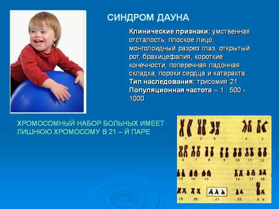 Причины заболевания дауна. Мозаичный Тип синдрома Дауна кариотип. Болезнь Дауна трисомия. Кариотип человека с болезнью Дауна. Дети с синдромом Дауна трисомия 21.