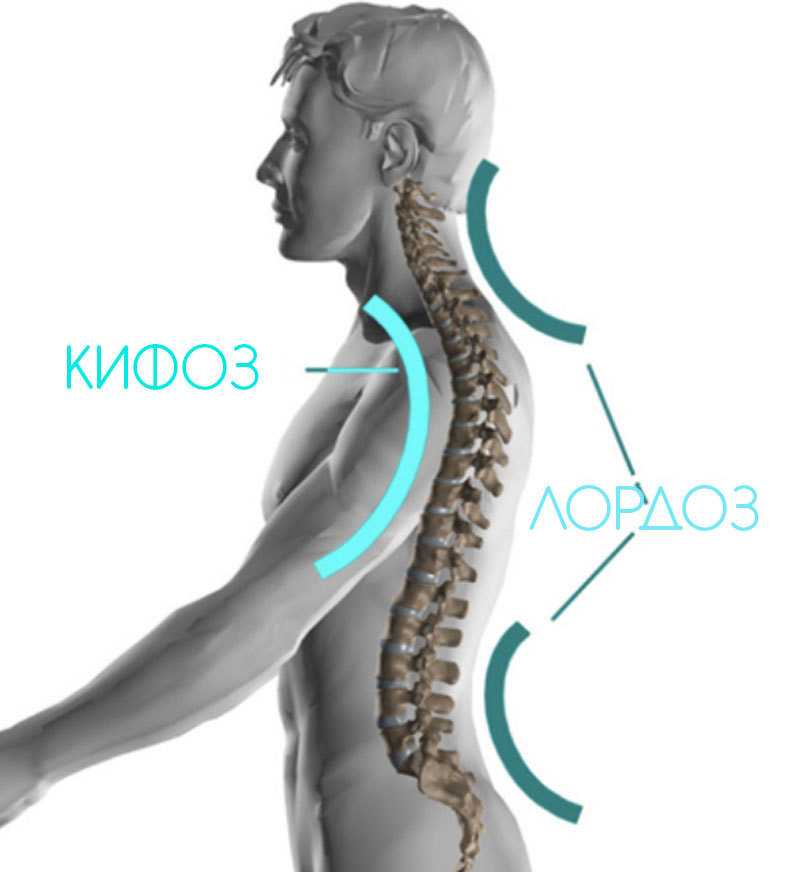 Кифоз шейного отдела что это фото