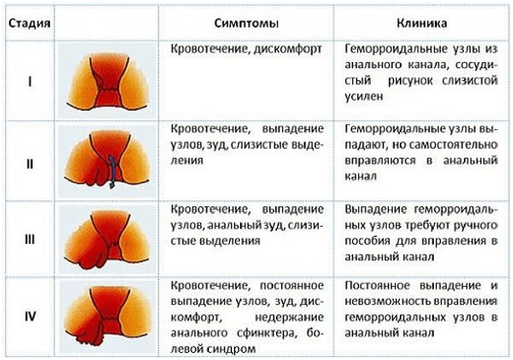 Можно ли задним. Геморрой наружный третья стадия. Клинические проявления геморроя. Расположение геморроидальных узлов по часам схема. Стадии хронического геморроя.