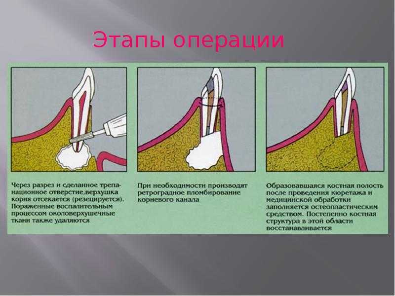 Верхушками разбор