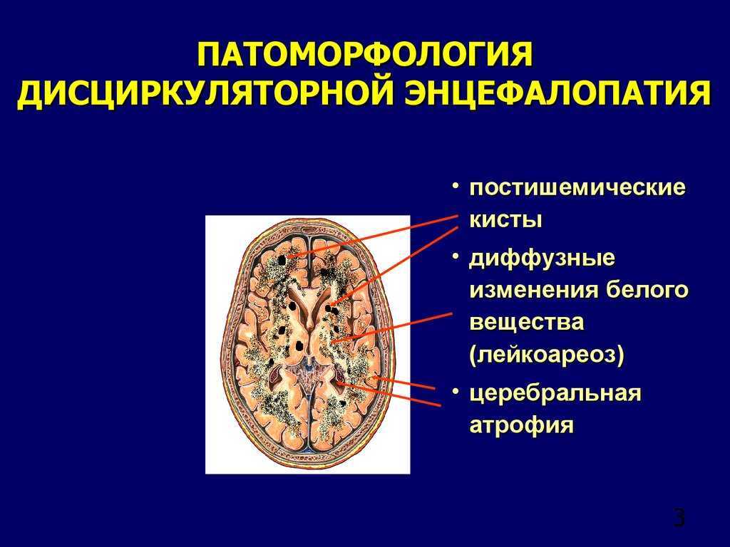 Энцефалопатия ️: симптомы, признаки и лечение энцефалопатии мозга