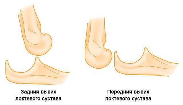 Упала на локоть больно сгибать. Задний вывих локтевого сустава. Медиальный вывих локтевого сустава. Передний вывих локтевого сустава.