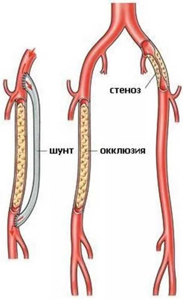 Стентирование подвздошных, бедренных артерий, протезирование бедренных артерий