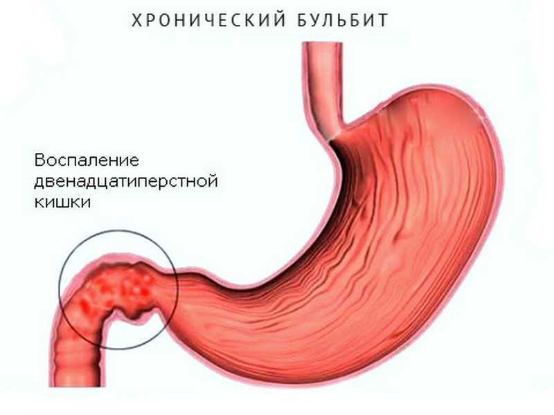 Причины развития такой неприятной патологии как бульбит во многом сходны с факторами, вызывающими появление одного из самых часто диагностируемых