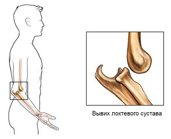 Боль в локтевом суставе | артракам