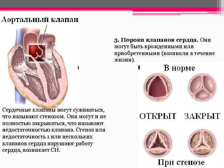 Уплотнение стенок аорты и створок аортального клапана