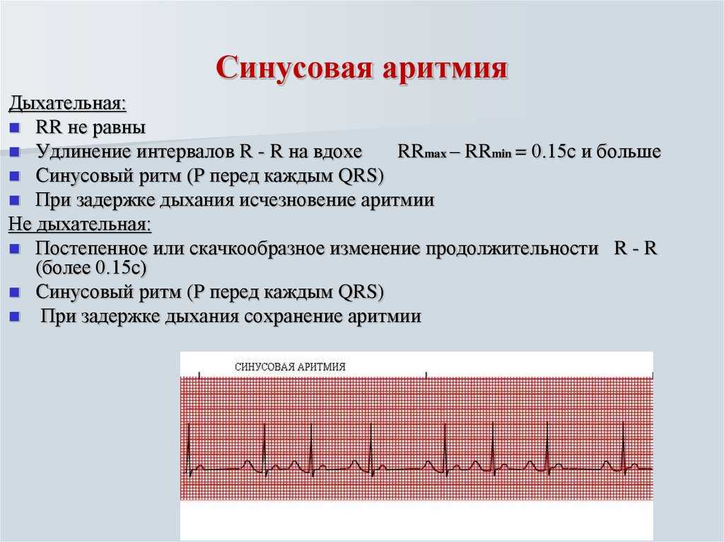 Низкий пульс