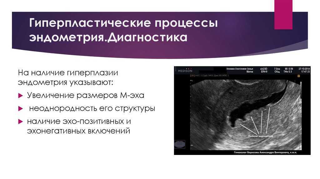 Атипическая гиперплазия эндометрия УЗИ. Гиперпластические процессы эндометрия УЗИ. Ультразвуковые критерии гиперплазии эндометрия. Патология эндометрия матки на УЗИ.