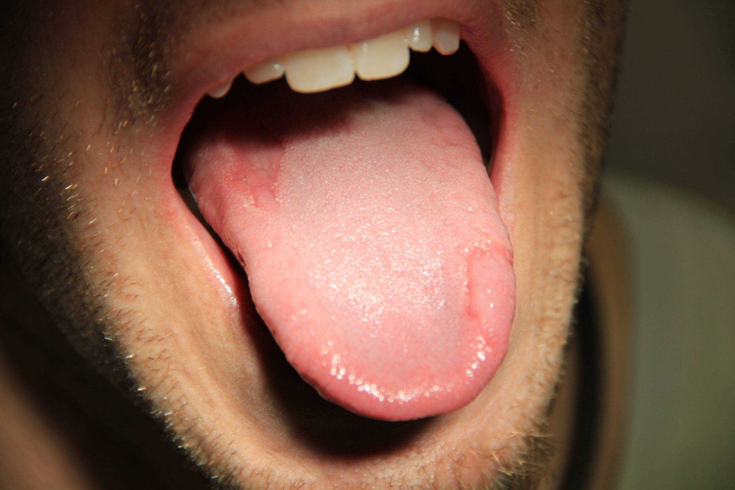 Если сухость во рту и вяжущие ощущения – единственные симптомы, которые ощущает человек, это может указывать на кариес, повышенную чувствительность десен