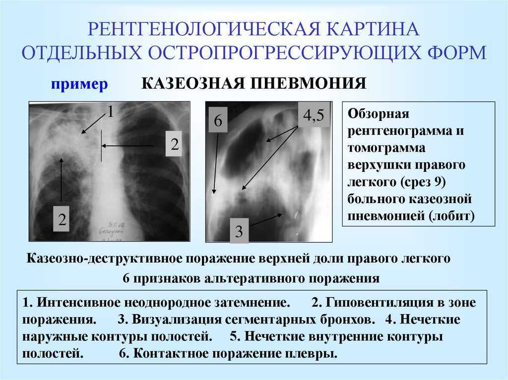 Рентген при туберкулезе - симптомы, признаки, описание рентгена при пневмонии