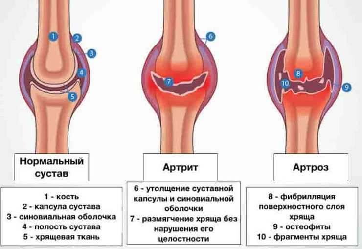 Внесуставные (системные) проявления ревматоидного артрита