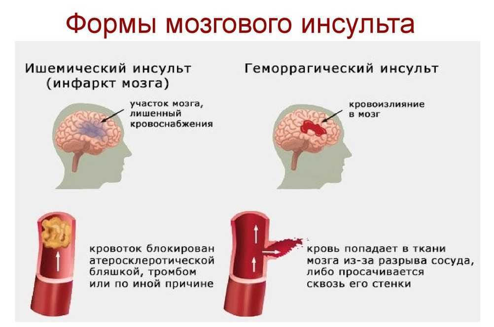 Геморрагический инсульт картинки