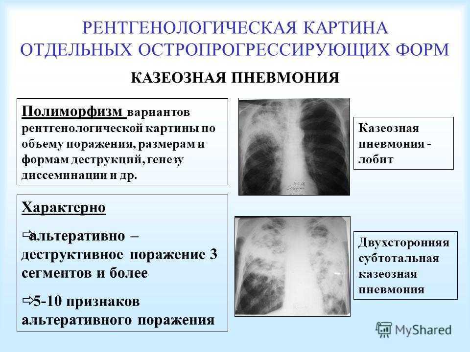 Очаговый туберкулез легких. диагностика и лечение. что такое туберкулёма.  :: ацмд